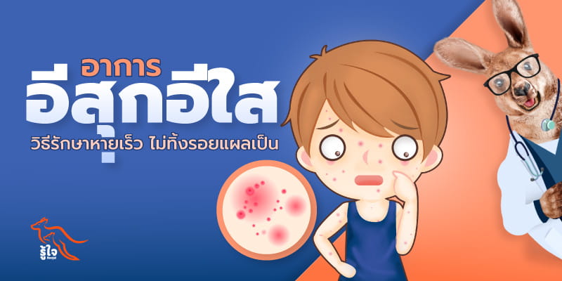 อาการอีสุกอีใสเป็นยังไง | ประกันออนไลน์ | รู้ใจ