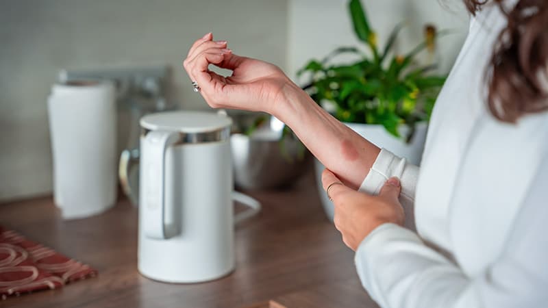 ระดับความรุนแรงของบาดแผลไฟไหม้ รู้ใจประกันภัย