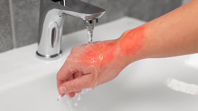 การปฐมพยาบาลเบื้องต้น เมื่อเกิดบาดแผลไฟไหม้ รู้ใจประกันภัย